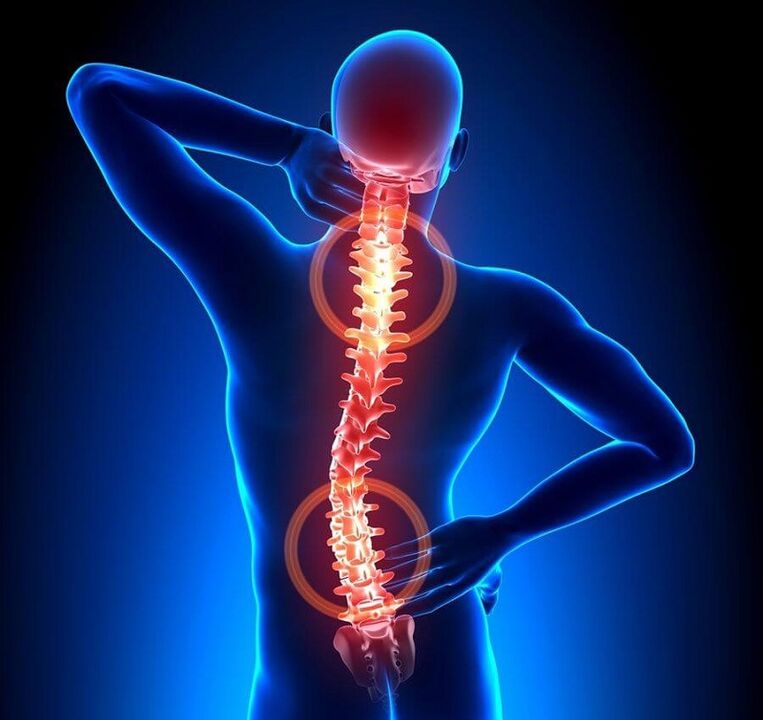 osteochondrosis of the spine as a cause of back pain