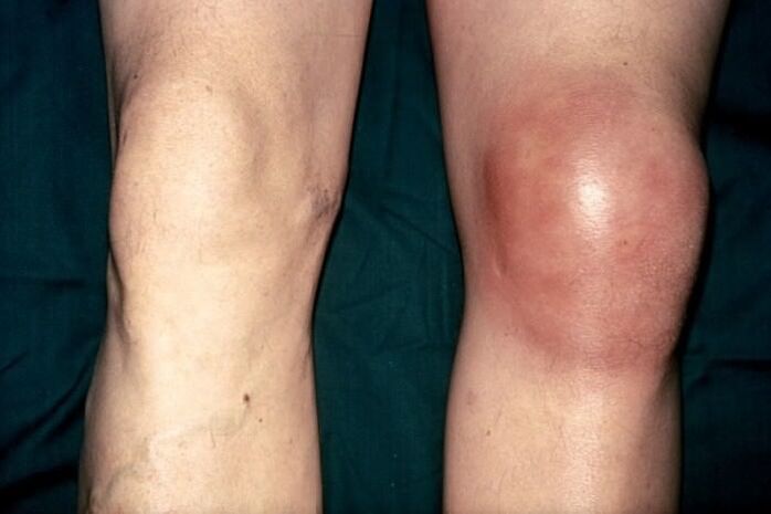 healthy swollen knee in pain
