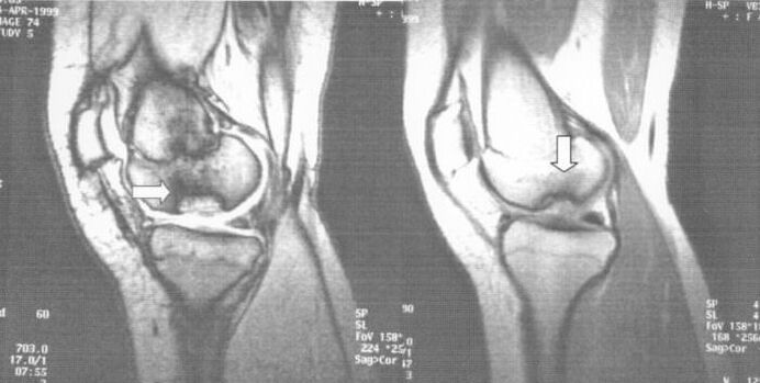 x-ray of osteochondrosis dissectant in the knee joint