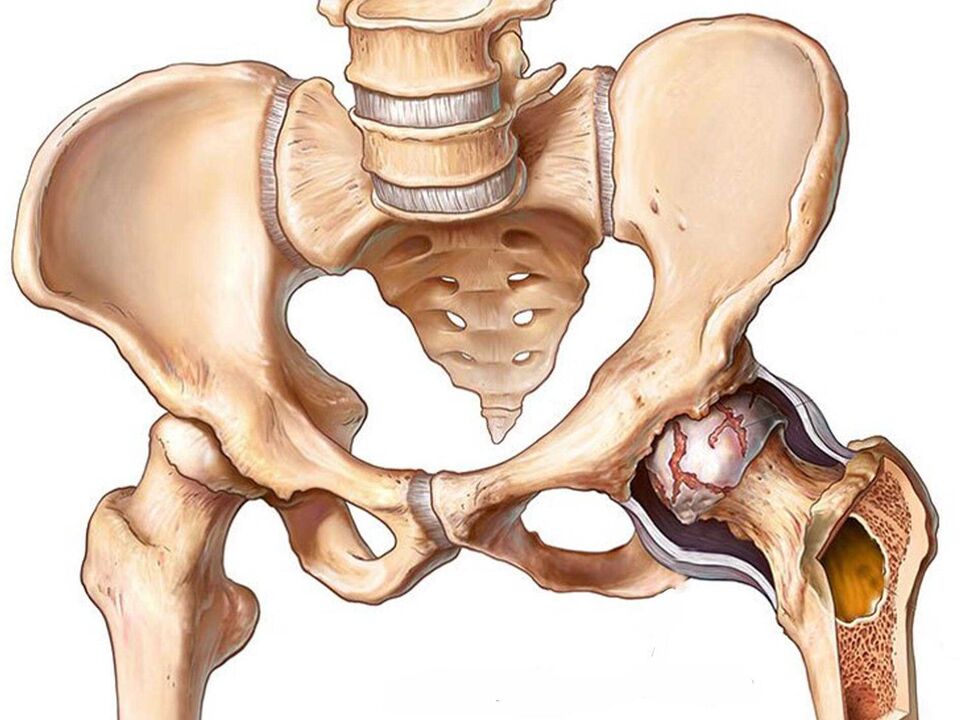 osteoarthritis of the hip joint