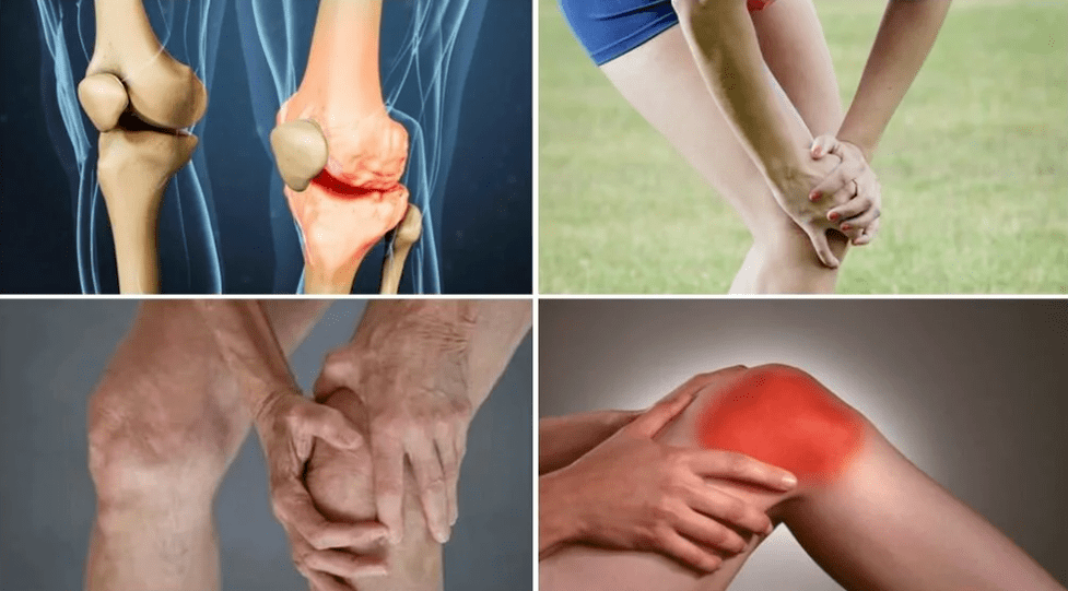 Osteoarthritis