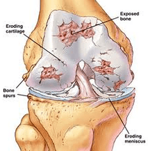 The arthritis development mechanism
